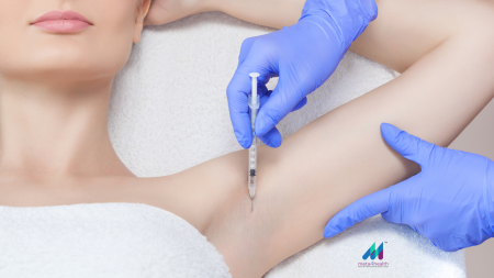 transpirație excesiva